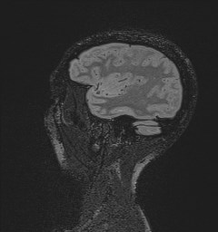 Central neurocytoma (Radiopaedia 84497-99872 Sagittal Flair + Gd 37).jpg