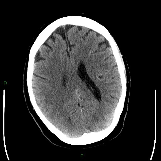 Cerebellar abscess (Radiopaedia 78135-90671 Axial non-contrast 69).jpg