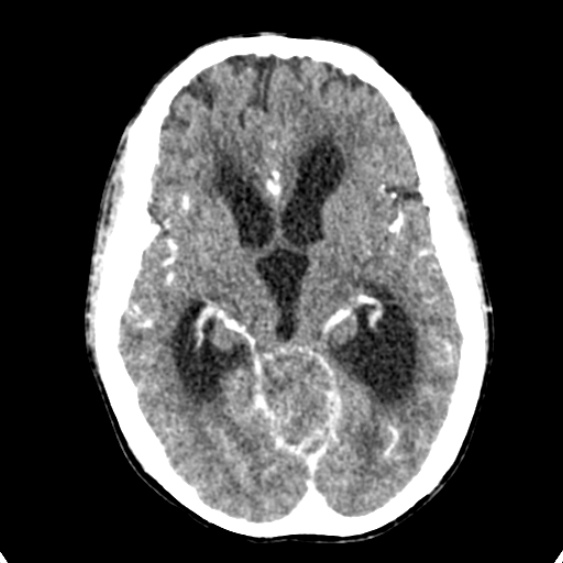 Cerebellar abscess secondary to mastoiditis (Radiopaedia 26284-26412 Axial C+ delayed 68).jpg