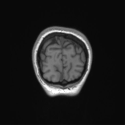 Cerebellar agenesis with hypoplastic pons (pontocerebellar hypoplasia) (Radiopaedia 57224-64138 Coronal T1 12).png