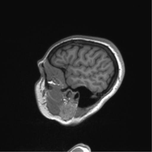 Cerebellar agenesis with hypoplastic pons (pontocerebellar hypoplasia) (Radiopaedia 57224-64138 Sagittal T1 55).png
