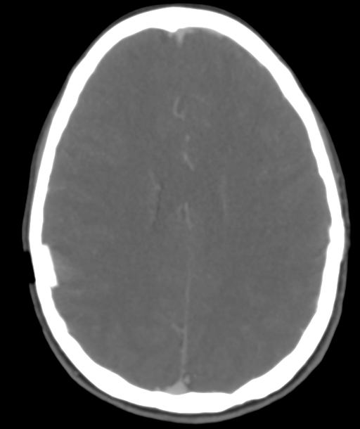 Cerebellar arteriovenous malformation- with hemorrhage (Radiopaedia 35752-37297 B 34).png