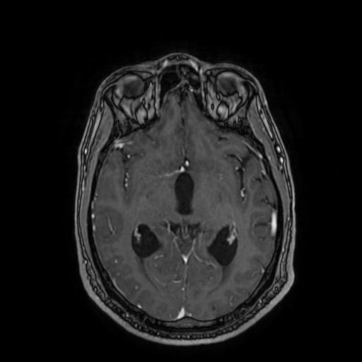 Cerebellar hemangioblastoma (Radiopaedia 88055-104622 Axial T1 C+ 89).jpg