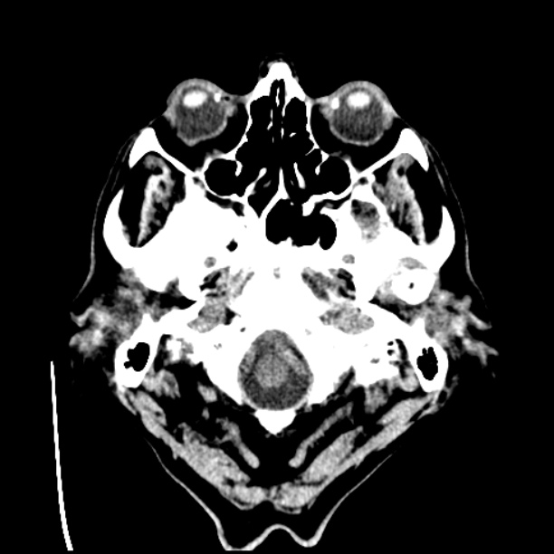 Cerebellar hemorrhage (Radiopaedia 27193-27359 Axial non-contrast 1).jpg