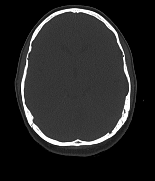 Cerebellar metastases - colorectal adenocarcinoma (Radiopaedia 40947-43652 AX Bone C- 2.0 MPR 25).png