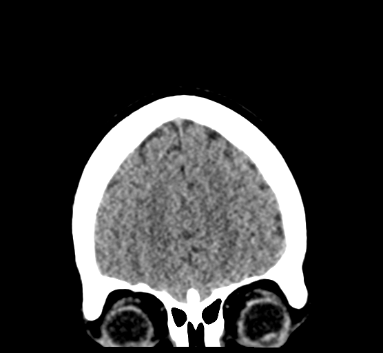 Cerebellar metastases - colorectal adenocarcinoma (Radiopaedia 40947-43652 Coronal non-contrast 20).png