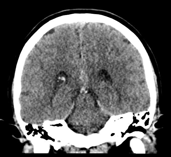 Cerebellar metastases - colorectal adenocarcinoma (Radiopaedia 40947-43652 Coronal non-contrast 59).png