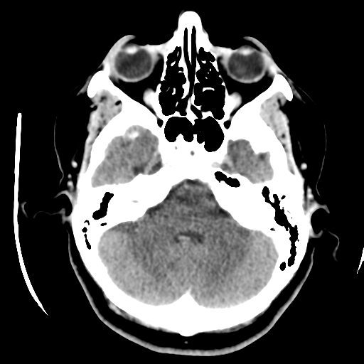 Cerebellar metastasis (cystic appearance) (Radiopaedia 41395-44258 B 13).png