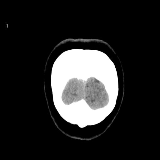 Cerebellar metastasis (cystic appearance) (Radiopaedia 41395-44258 Coronal non-contrast 59).png