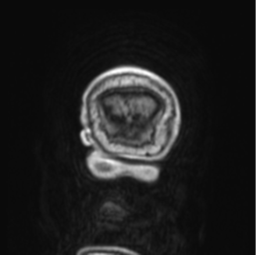File:Cerebellar metastasis from lung adenocarcinoma (Radiopaedia 86690-102829 Coronal T1 C+ 1).png