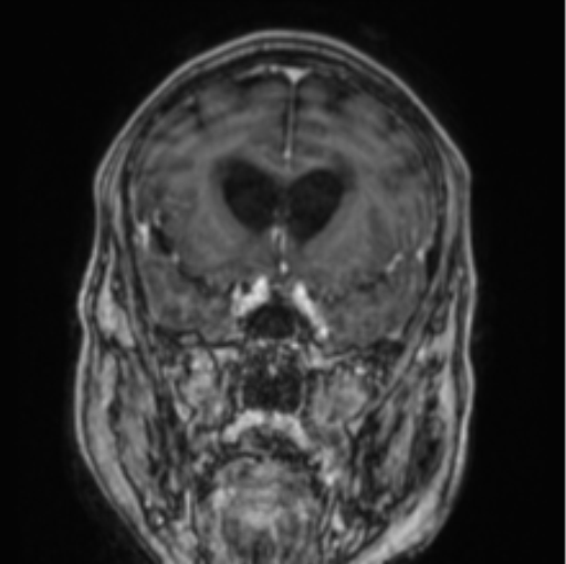 File:Cerebellar metastasis from lung adenocarcinoma (Radiopaedia 86690-102829 Coronal T1 C+ 66).png