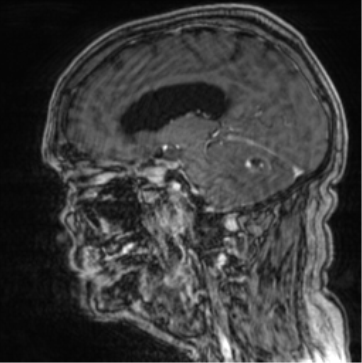 Cerebellar metastasis from lung adenocarcinoma (Radiopaedia 86690-102829 Sagittal T1 C+ 35).png