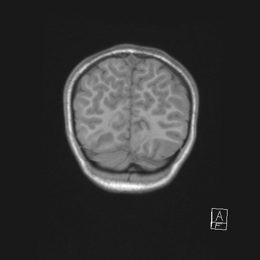 Cerebellar stroke (Radiopaedia 32202-33150 Coronal T1 54).png