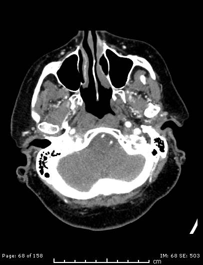 Cerebellar strokes due to intracranial giant cell arteritis (Radiopaedia 68799-78510 CT angiogram 68).jpg