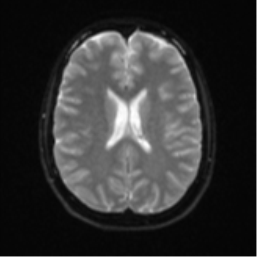 Cerebellar tuberculomas (Radiopaedia 46939-51472 Axial DWI 18).png