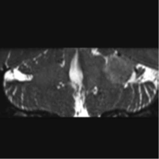 File:Cerebellopontine angle meningioma (Radiopaedia 48434-53348 Coronal T2 31).png