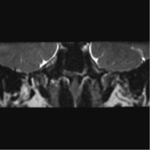 Cerebellopontine angle meningioma (Radiopaedia 48434-53348 Coronal T2 71).png