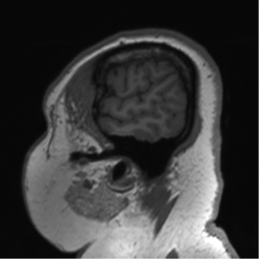 Cerebellopontine angle meningioma (Radiopaedia 48434-53348 Sagittal T1 79).png