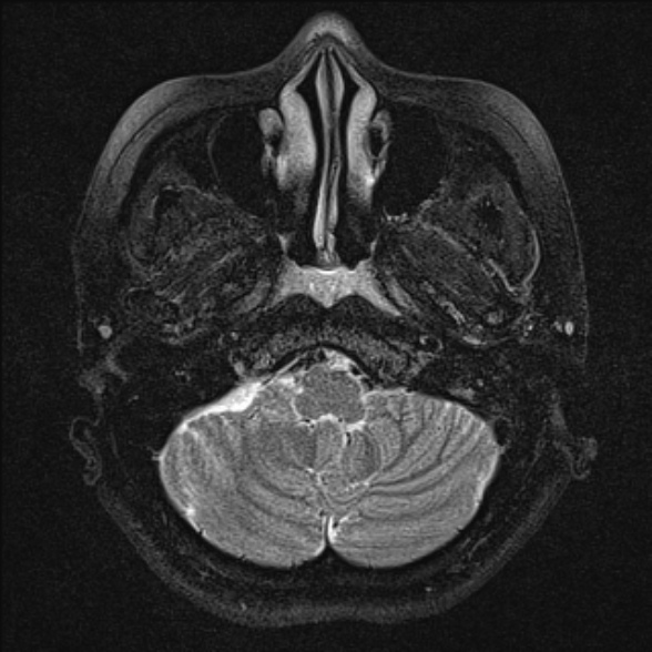 File:Cerebellopontine angle meningioma (Radiopaedia 53561-59591 Axial T2 fat sat 6).jpg
