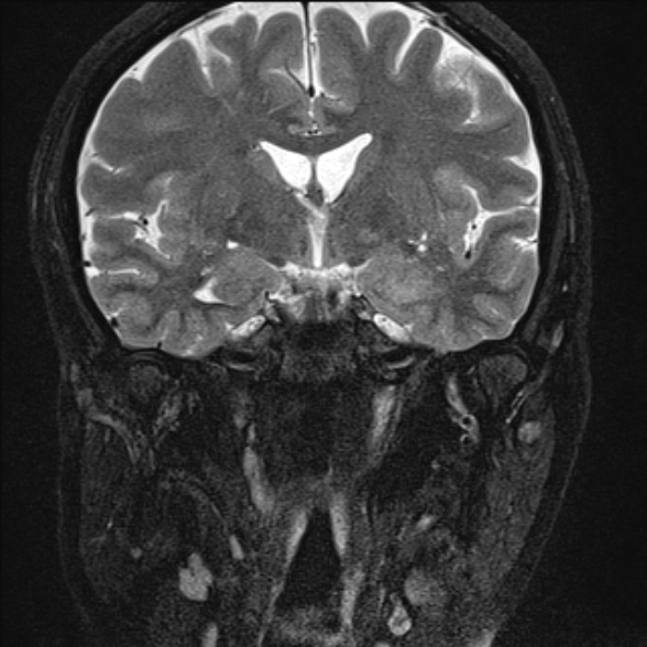 File:Cerebellopontine angle meningioma (Radiopaedia 53561-59591 Coronal T2 5).jpg
