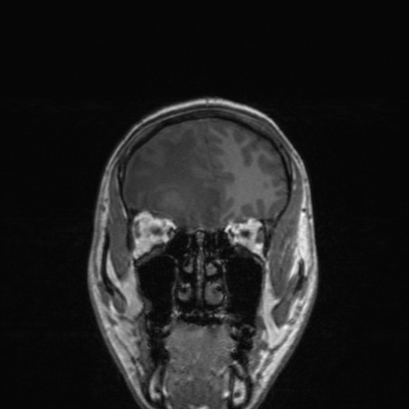 File:Cerebral abscess (Radiopaedia 24212-24478 Coronal T1 58).jpg