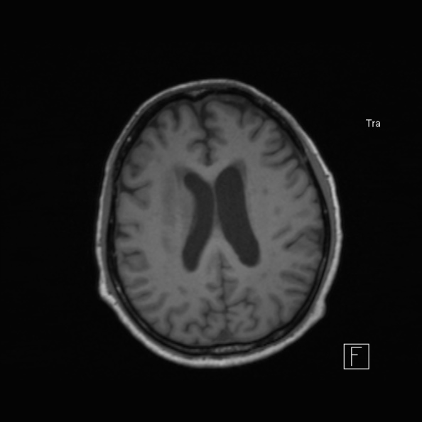 Cerebral abscess (Radiopaedia 26111-26247 Axial T1 39).jpg
