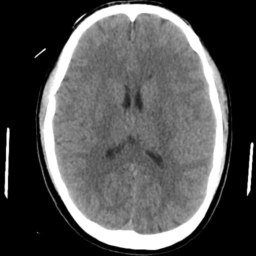 File:Cerebral abscess (Radiopaedia 29451-29919 Axial non-contrast 28).jpg