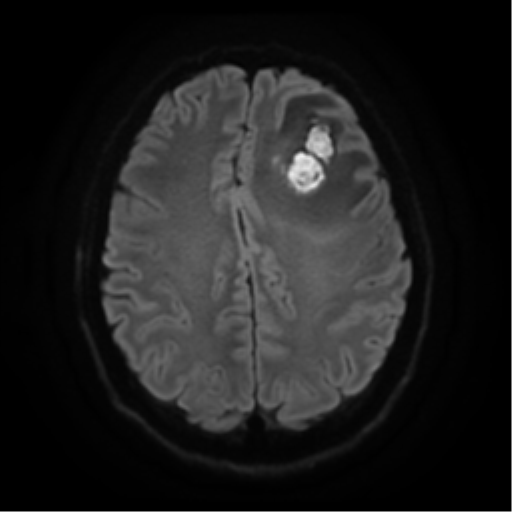 Cerebral abscess (Radiopaedia 57774-64740 Axial DWI 20).png