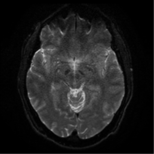 Cerebral abscess (Radiopaedia 57774-64740 Axial DWI 41).png