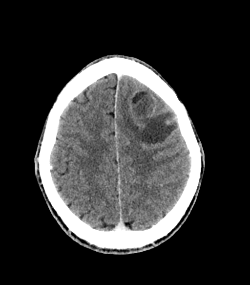Cerebral abscess (Radiopaedia 57774-64741 Axial C+ delayed 49).png