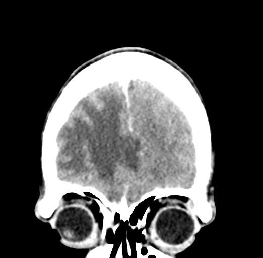Cerebral abscess (Radiopaedia 60342-68008 Coronal C+ delayed 12).png