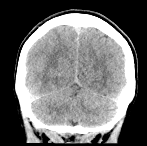 File:Cerebral abscess (Radiopaedia 60342-68008 Coronal non-contrast 50).png