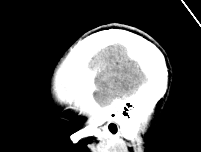 Cerebral abscess (Radiopaedia 60342-68008 Sagittal C+ delayed 6).png