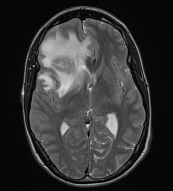 File:Cerebral abscess (Radiopaedia 60342-68009 Axial T2 17).png