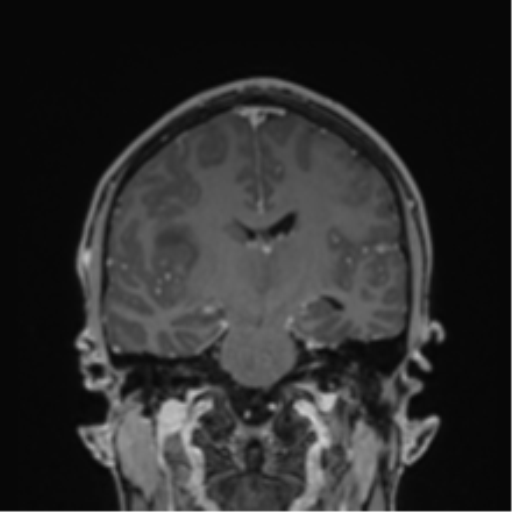 Cerebral abscess (Radiopaedia 60342-68009 H 23).png
