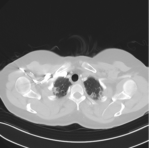 File:Cerebral abscess from pulmonary arteriovenous malformation (Radiopaedia 86275-102292 Axial lung window 10).png