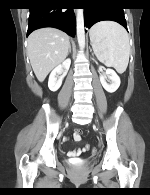 Cerebral abscess from pulmonary arteriovenous malformation (Radiopaedia 86275-102292 D 33).png