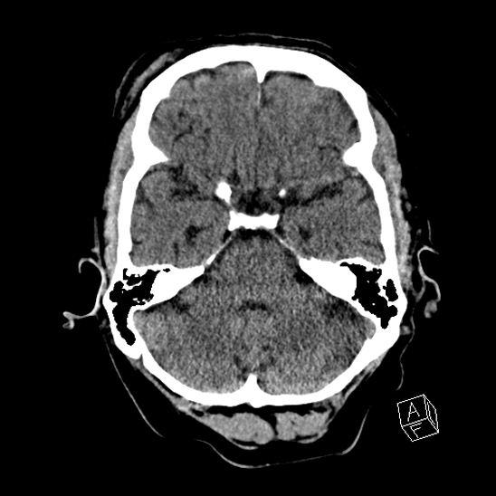 Cerebral abscess with ventriculitis (Radiopaedia 78965-91876 Axial non-contrast 16).jpg