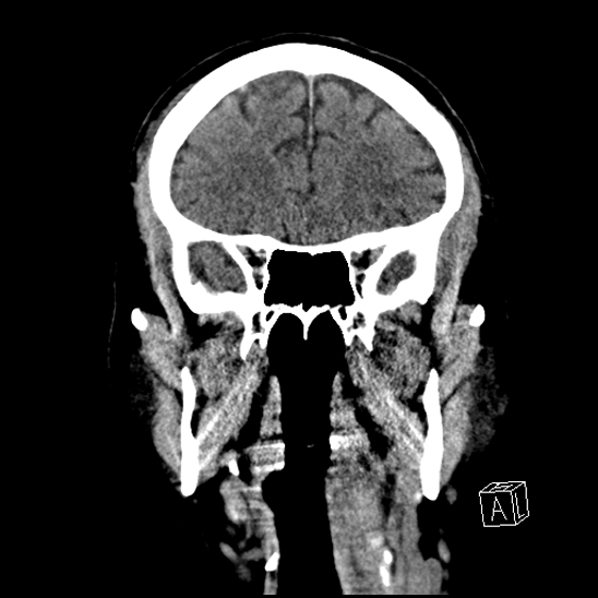 File:Cerebral abscess with ventriculitis (Radiopaedia 78965-91876 B 17).jpg