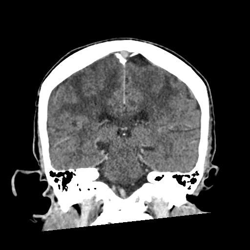 Cerebral amyloid angiopathy-related inflammation (Radiopaedia 74836-85848 Coronal non-contrast 43).jpg