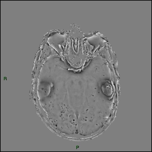 Cerebral amyloid angiopathy (Radiopaedia 77506-89664 H 41).jpg