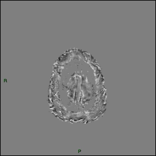 Cerebral amyloid angiopathy (Radiopaedia 77506-89664 H 98).jpg