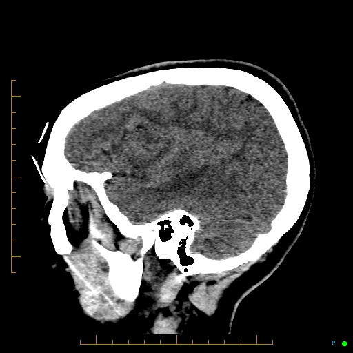 Cerebral arteriovenous malformation (AVM) (Radiopaedia 78162-90706 A 18).jpg