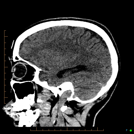 Cerebral arteriovenous malformation (AVM) (Radiopaedia 78162-90706 A 55).jpg