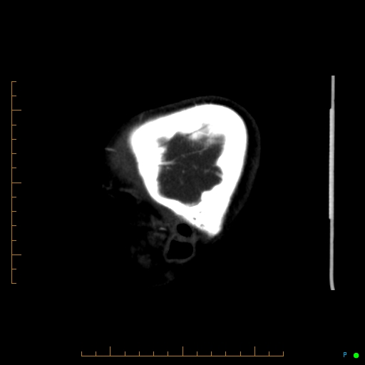 Cerebral arteriovenous malformation (AVM) (Radiopaedia 78162-90706 Sagittal CTA 72).jpg