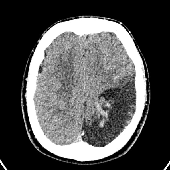Cerebral arteriovenous malformation (Radiopaedia 37182-39012 Axial non-contrast 35).jpg