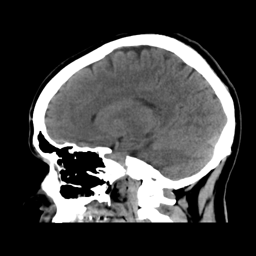 File:Cerebral arteriovenous malformation (Radiopaedia 39259-41505 B 22).png