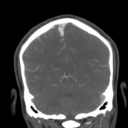 Cerebral arteriovenous malformation (Radiopaedia 39259-41505 E 46).png