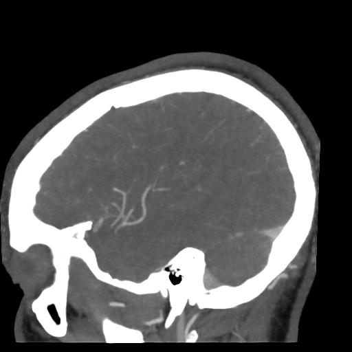 File:Cerebral arteriovenous malformation (Radiopaedia 39259-41505 Sagittal 48).png