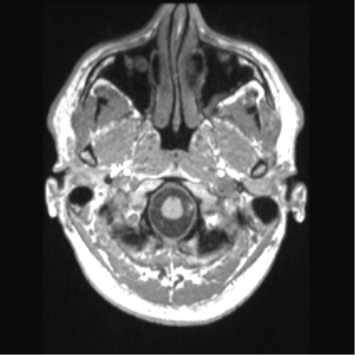 Cerebral arteriovenous malformation (Radiopaedia 39259-41506 Axial T1 9).png